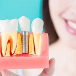 Rateizzazione Impianti Dentali Parma: Centro Odontoiatrico AKOS