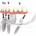 Impianti Dentali All on four 4 con Chirurgia Guidata Parma Carpi Modena Reggio Emilia Fiorenzuola | AKOS Centro Odontoiatrico