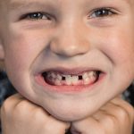 Malocclusione dentale nei bambini e ortodonzia intercettiva | Centro Odontoiatrico AKOS Dental Care Parma Fiorenzuola Piacenza Fidenza Reggio Emilia