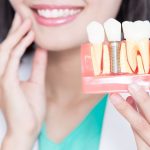 Impianti Dentali: La Soluzione Ideale per un Sorriso Naturale e Duraturo | Centro Odontoiatrico AKOS Parma Piacenza Casalmaggiore Fidenza Cremona