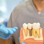 Manutenzione degli Impianti Dentali: Consigli e Buone Pratiche per una Lunga Durata | Centro Odontoiatrico AKOS Parma Piacenza Casalmaggiore Fidenza Cremona