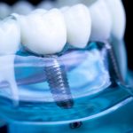 Novità sugli Impianti Dentali: Le Ultime Tecnologie per un Recupero Rapido e Sicuro | Centro Odontoiatrico AKOS Parma Piacenza Casalmaggiore Fidenza Cremona