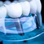 Innovazioni in Implantologia Dentale per il 2025 Centro Odontoiatrico AKOS Dental Care Parma e Casalmaggiore Fidenza Cremona Fiorenzuola