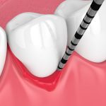 Parodontite: cause, sintomi e come riconoscerla in tempo | Centro Odontoiatrico AKOS Dental Care Parma e Casalmaggiore Fidenza Cremona Fiorenzuola