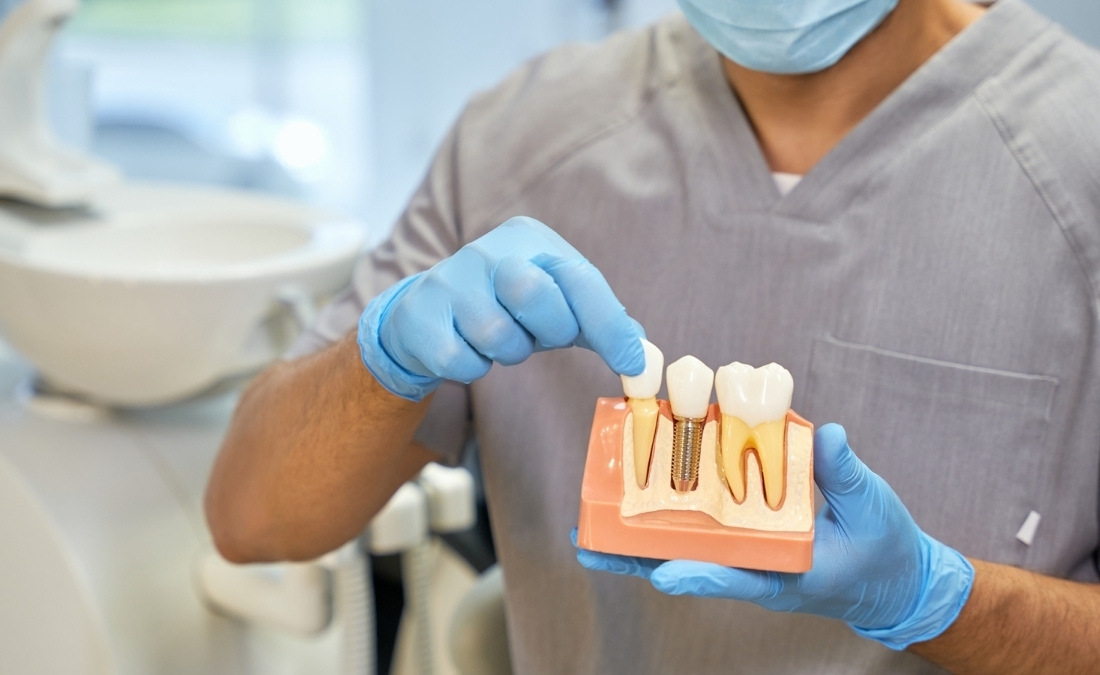 Rigenerazione ossea per impianti dentali