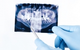 La rigenerazione ossea dentale per i tuoi denti definitivi