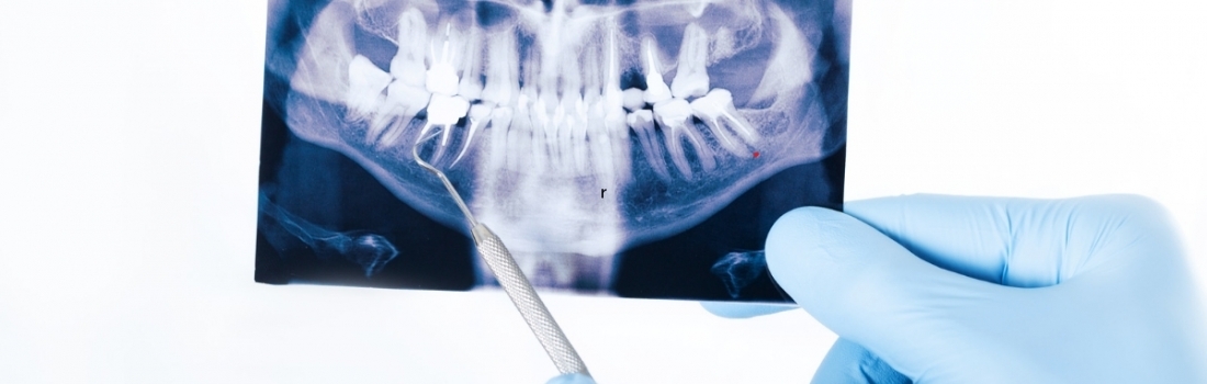 La rigenerazione ossea dentale per i tuoi denti definitivi