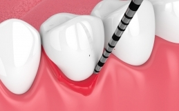 La parodontite può causare perdita di osso dentale