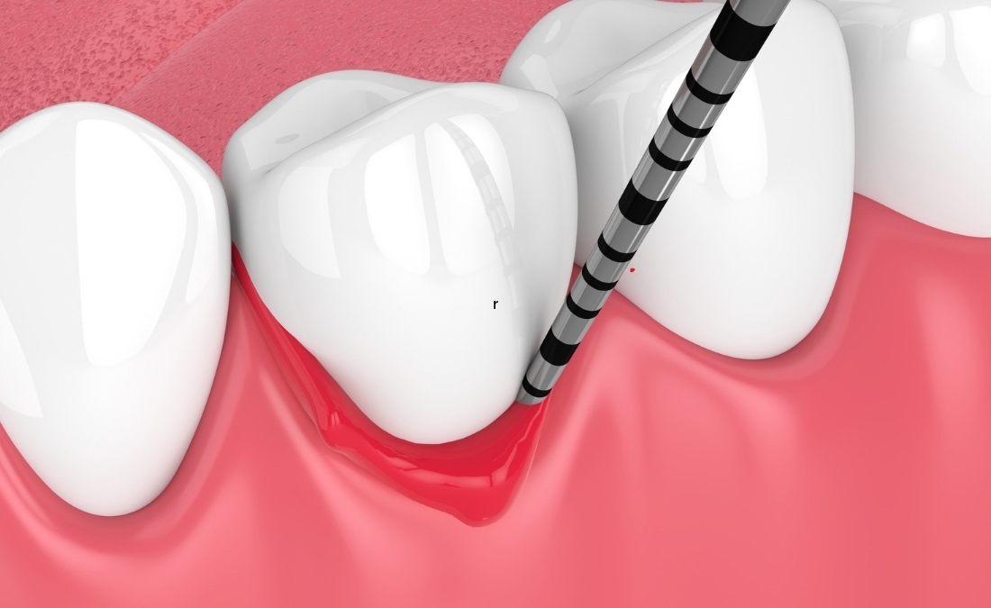 La parodontite può causare perdita di osso dentale