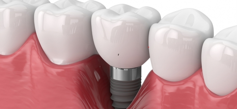 Dopo l’osteointegrazione si possono impiantare i nuovi denti