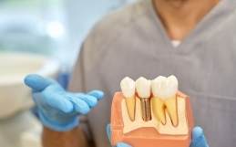 Manutenzione degli Impianti Dentali: Consigli e Buone Pratiche per una Lunga Durata