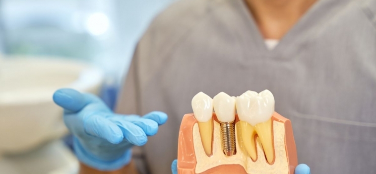 Manutenzione degli Impianti Dentali: Consigli e Buone Pratiche per una Lunga Durata