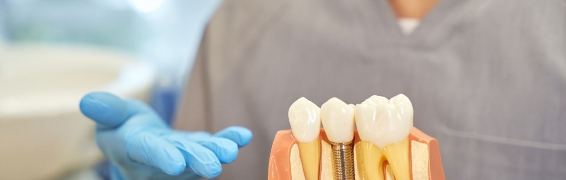 Manutenzione degli Impianti Dentali: Consigli e Buone Pratiche per una Lunga Durata