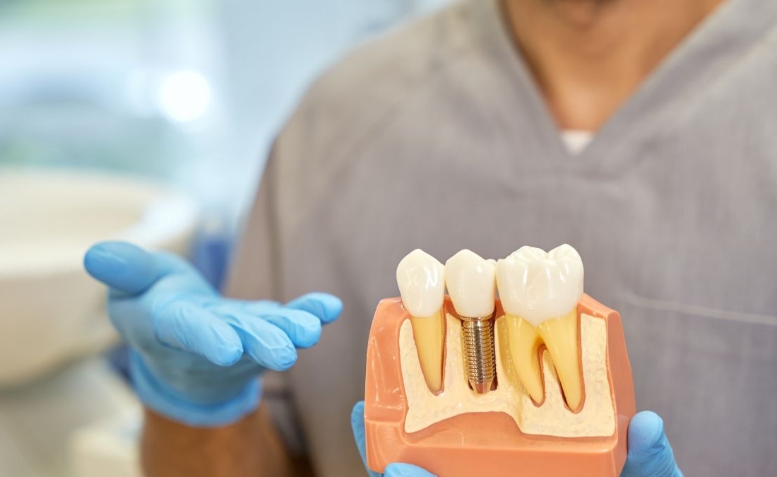 Manutenzione degli Impianti Dentali: Consigli e Buone Pratiche per una Lunga Durata