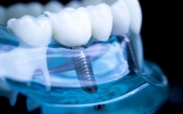 Novità sugli Impianti Dentali: Le Ultime Tecnologie per un Recupero Rapido e Sicuro