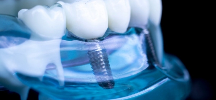 Novità sugli Impianti Dentali: Le Ultime Tecnologie per un Recupero Rapido e Sicuro