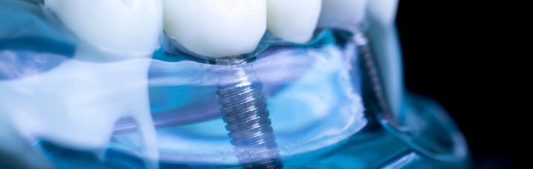 Novità sugli Impianti Dentali: Le Ultime Tecnologie per un Recupero Rapido e Sicuro