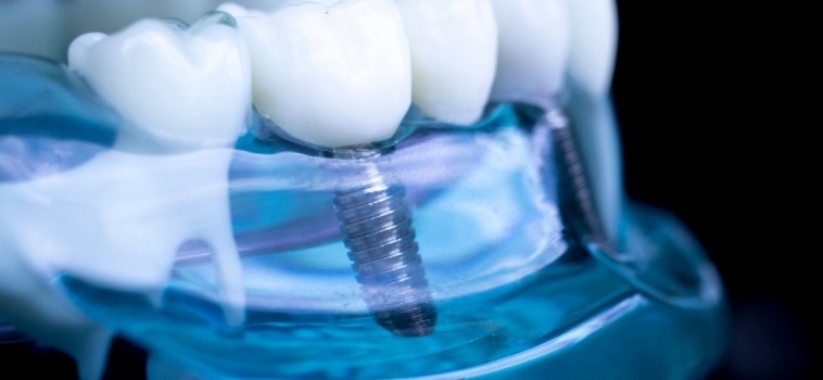 Innovazioni in Implantologia Dentale per il 2025