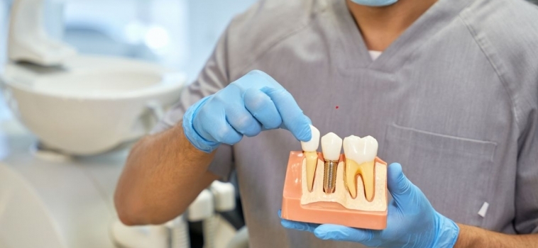 IMPIANTI DENTALI: Settembre, il Tempo Giusto per Iniziare!