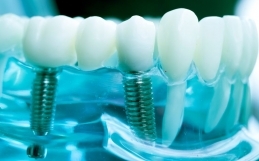 IMPLANTOLOGIA DENTALE AKOS: Affidati a Specialisti di Eccellenza!