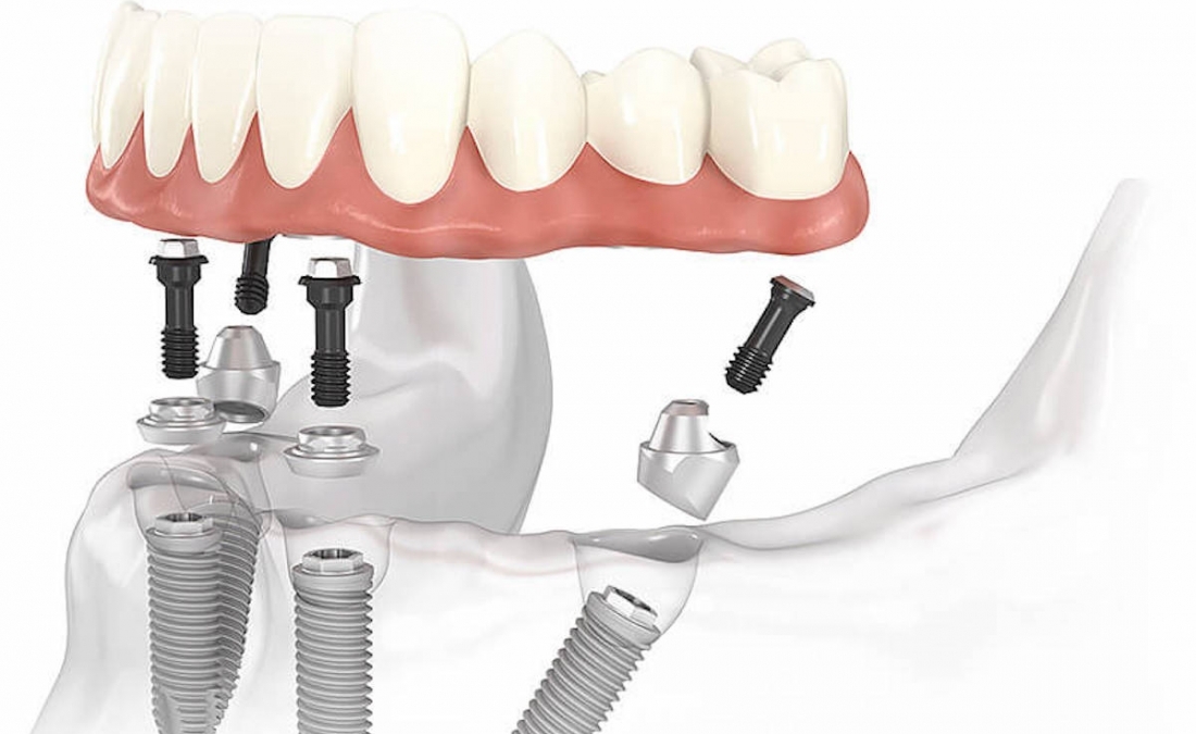 Impianti Dentali All on four 4 con Chirurgia Guidata