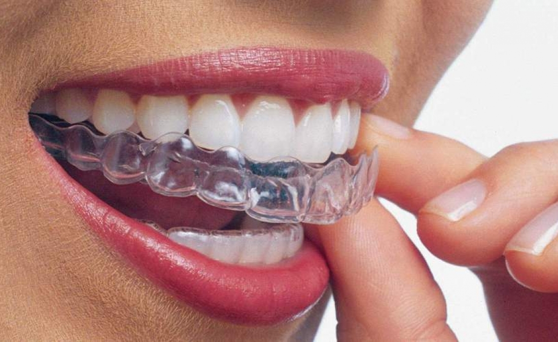 ALLINEAMENTO DENTI INVISIBILE