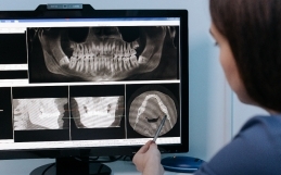 Il Ruolo della Diagnostica per Immagini negli Impianti Zigomatici