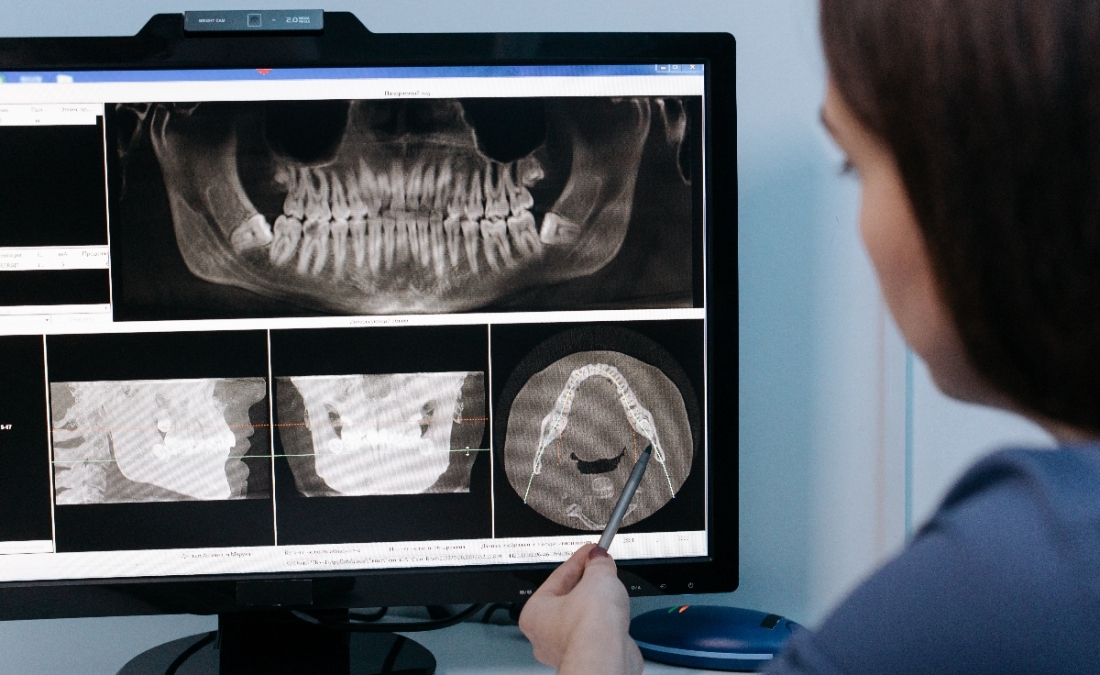 Implantologia Dentale Arcata Superiore e Inferiore