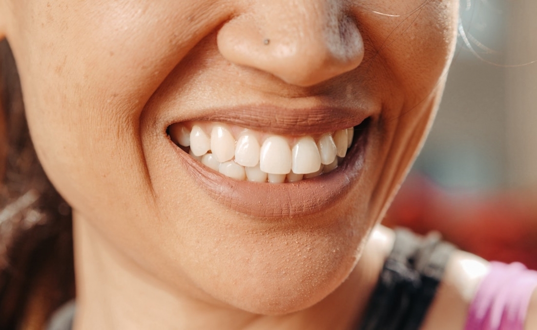 I tre tipi di Malocclusione Dentale